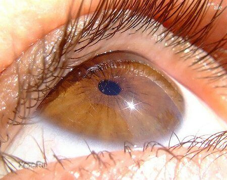 Синдром сухого ока